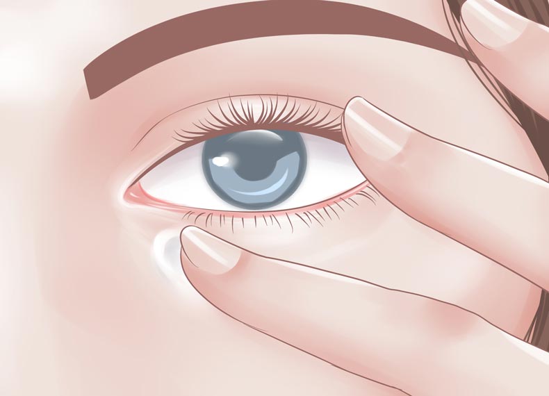 درمان قطعی پف زیر چشم