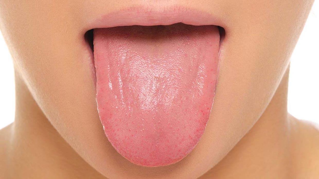 سفیدی زبان را در 3 سوت درمان کنید !! ( با عکس )
