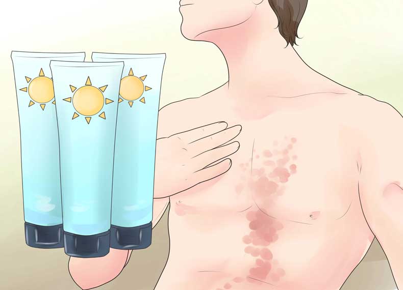 استفاده از کرم ضد آفتاب برای پسوریازیس