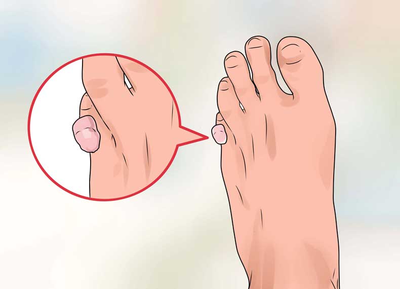 درمان تاول پا
