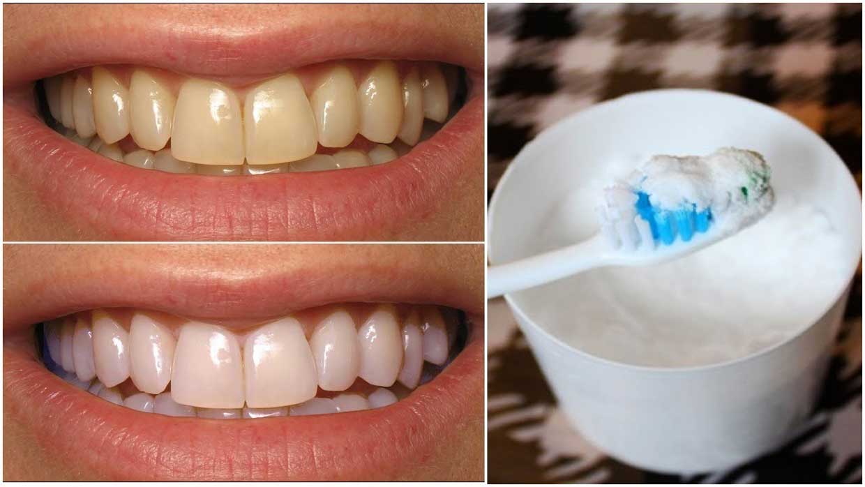 سفید کردن دندان با جوش شیرین