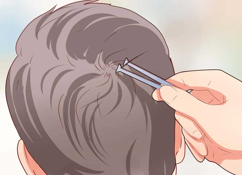 اندازه گیری میزان ریزش مو