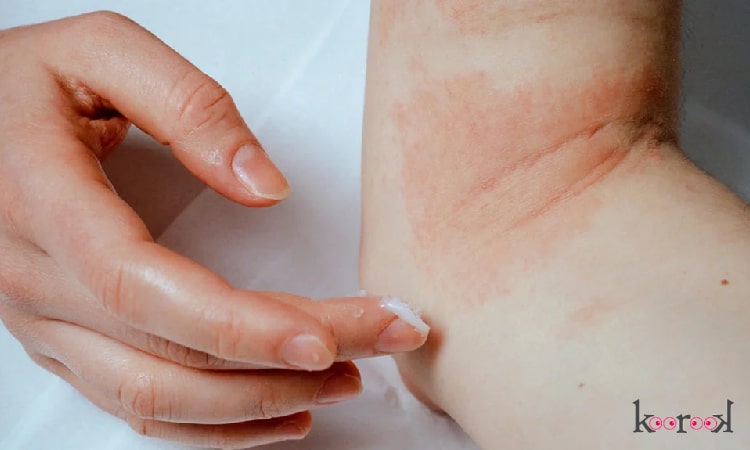 درمان بیماری اگزما پوستی
