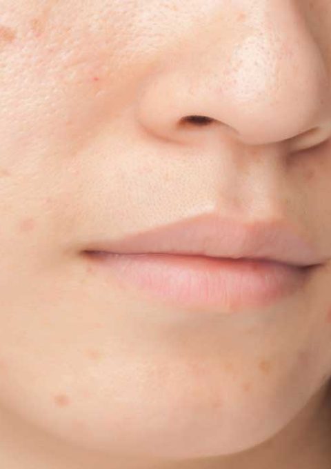 Fade-Acne-Scars-Step-www.koorook.com-20