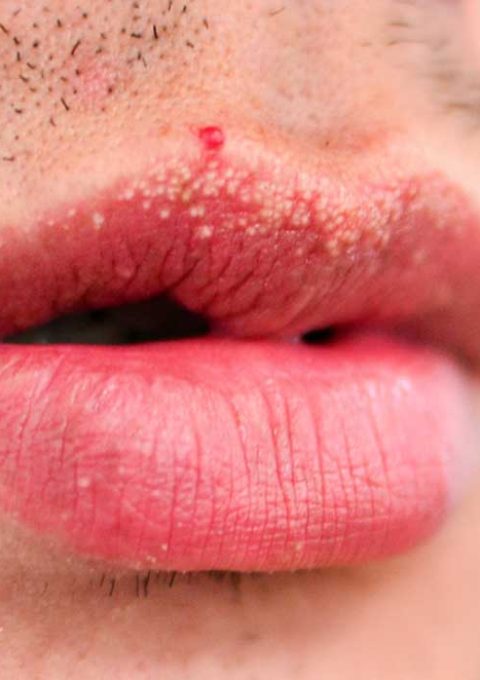 دانه‌های فوردایس