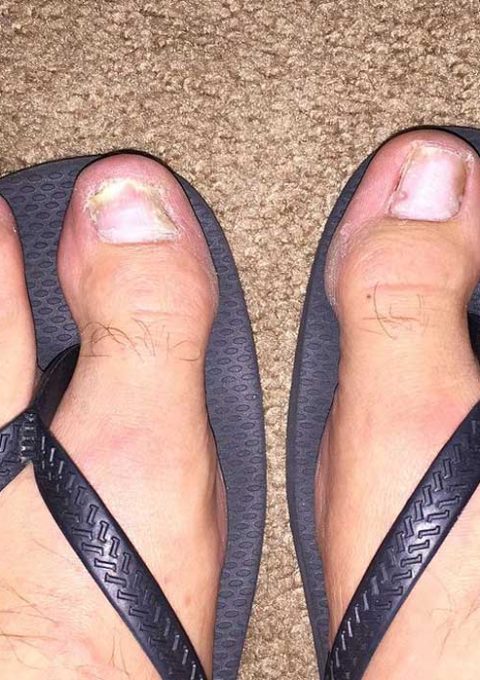 پسوریازیس ناخن