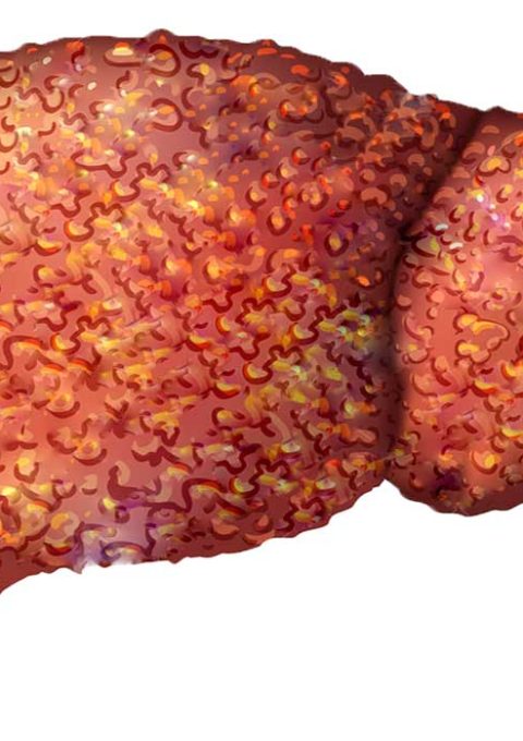 سیروز کبدی